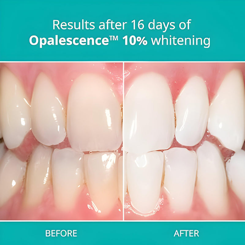 Opalescence 10% Gel Syringes Teeth Whitening - Refill Kit (4 Syringes Total) Carbamide Peroxide. Made by Ultradent, in Melon Flavor. Tooth Whitening Refill Syringes