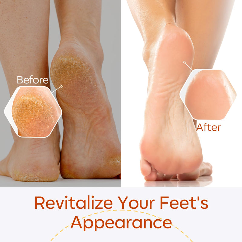 [Australia] - Modelones callus remover solution for gentle callus removal, quick-softening lotion - 240ml 