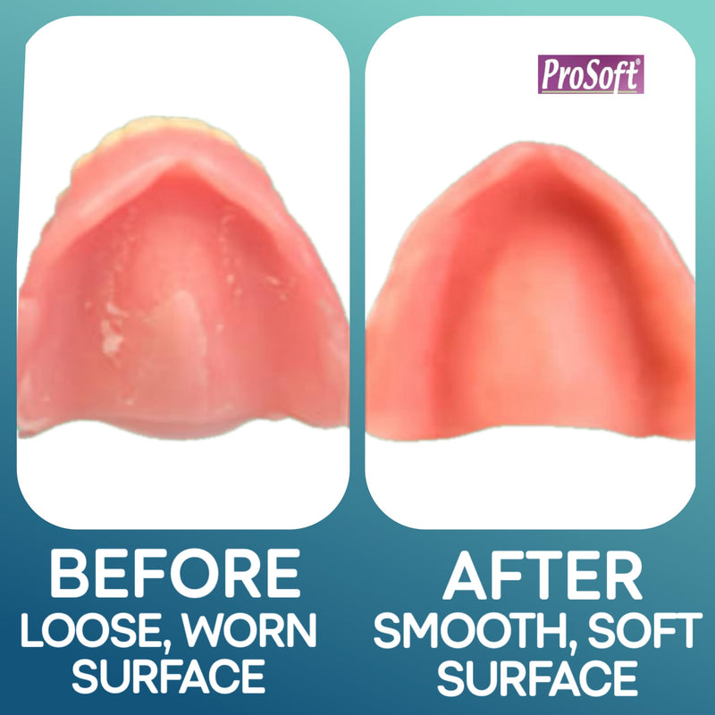 [Australia] - ProSoft Denture Reliner-Relines 2 Denture Plates 