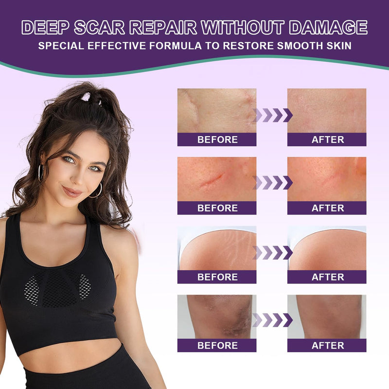 [Australia] - Silicone Scar Cream Scar Gel - Advanced Scar Gel Scar Treatment for Stretch Marks Removal, Old & New Scars, Surgical Scars, Burns, Acne, C-Section, Keloid Scar Treatment for Women & Men, 1.76Oz 