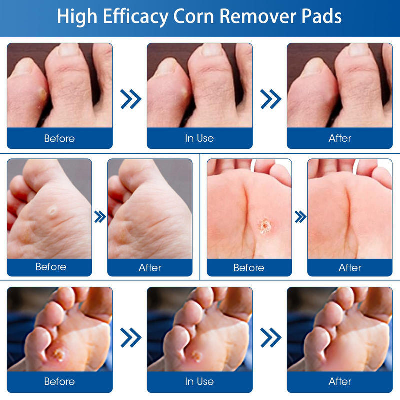 [Australia] - 24 Count Corn Removal Pads for Feet and Toe, Corn Feet Remover for Feet Extra Strength, Callous Remover 24 Beige 