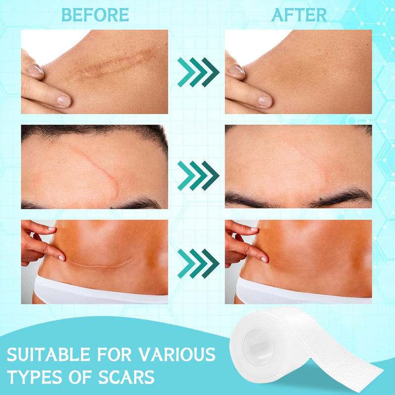[Australia] - Volhuluk Transparent Silicone Scar Plaster (4x150cm), Silicone Plaster Professional for C-Section Scars, Operations, Burns, Keloid, Acne and More, Silicone Plaster for Scars 