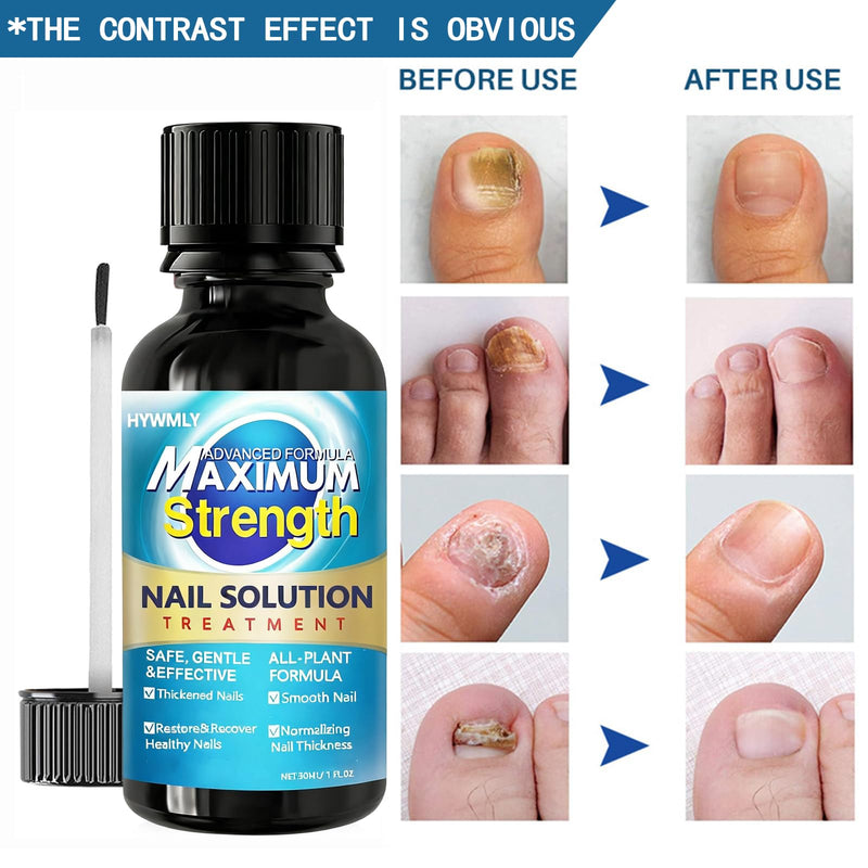 [Australia] - Toenail Fungus Treatment Extra Strength, Toe Fungus Treatment for Toenail, Toe Nail fungus Treatment Extra Strength, Nail Treatment, Safely and Gently 1 Fl Oz (Pack of 1) 1 Fl Oz (Pack of 1) 