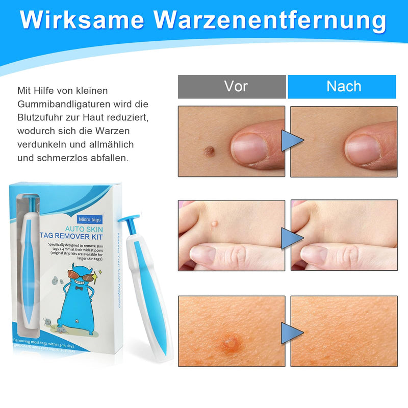 [Australia] - Scettar stalked wart remover, wart remover for micro to large (1mm-8mm) with 60 tag bands, safe and painless wart remover stalked warts A 