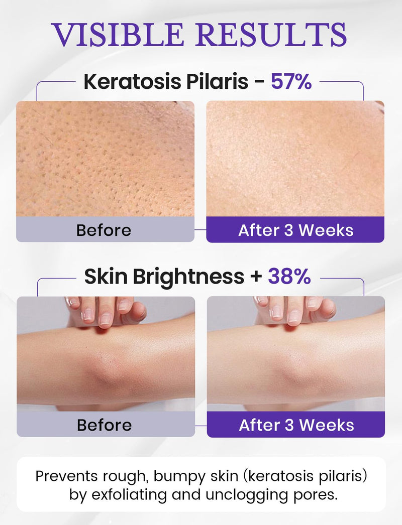 [Australia] - Elvira KP Bump Eraser Foot & Body Scrub, Exfoliating Scrub for Keratosis Pilaris, Smooth Skin with 10% AHA BHA & Niacinamide, Deep Moisturizing Cleanser for All Skin Types, Exfoliante para el Cuerpo UNSCENTED 