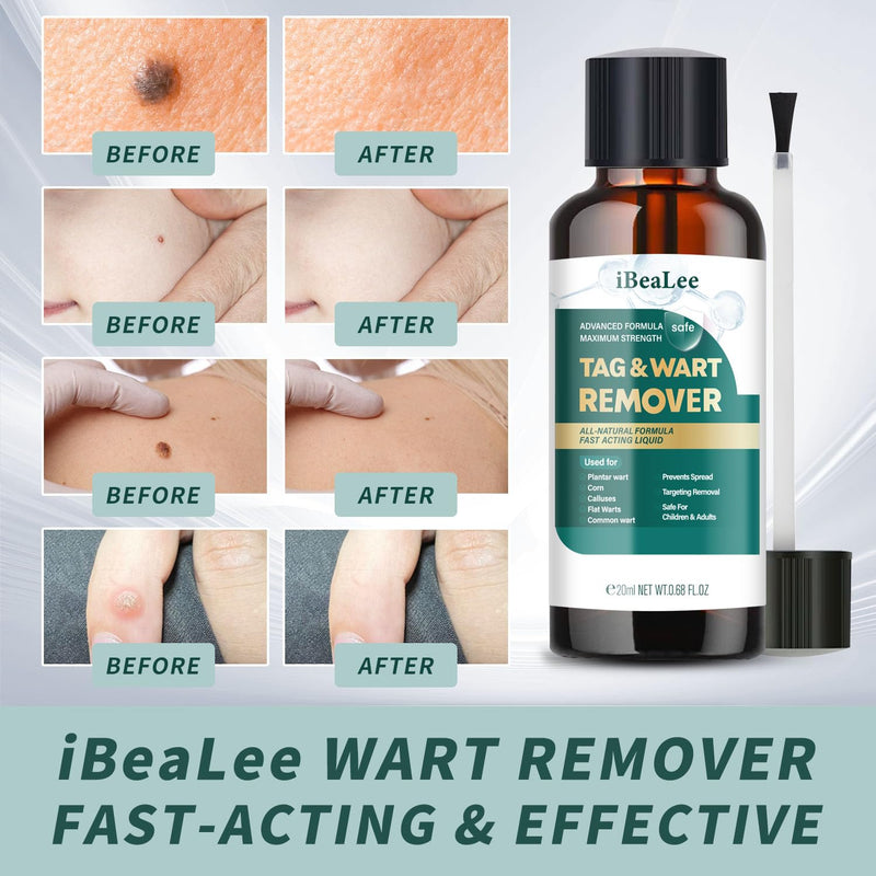 [Australia] - Wart Remover Liquid - 12% Wart Liquid with Salicylic Acid - Fast Acting Wart Freeze OffÔºåfor Warts, Plantar Wart, Genital Wart White 