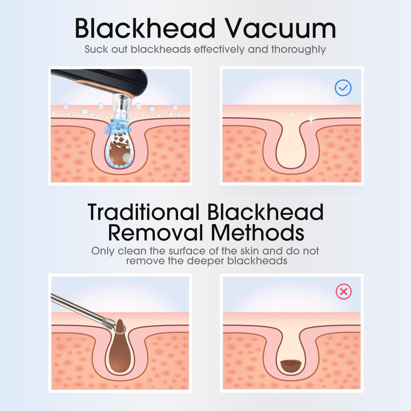 Yccu Blackhead Remover Vacuum Pore Extractor Black Head Remover for Face and Nose Blackhead Extractor Tool Pore Cleane Vacuum with USB Charge 4 Modes 5 Suction Heads for Women and Men (Black) 1 Count (Pack of 1)