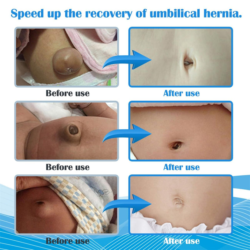 S Baby Umbilical Hernia Belt for Hernia Support and Recovery, Infant Belly Button Band Navel Truss Wrap - Soft, Skin-friendly
