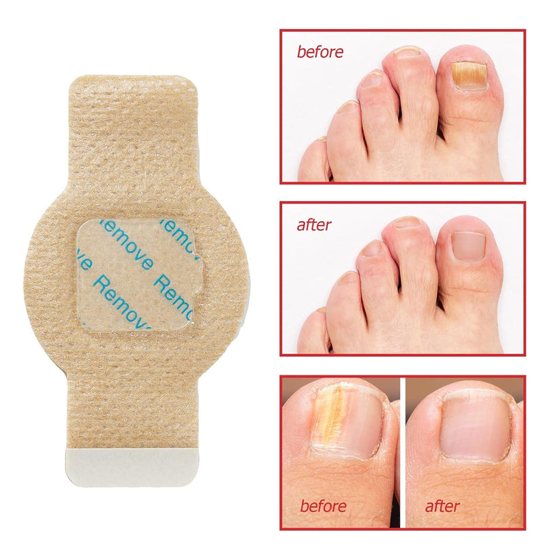 Nail Patches, Nail Patches for Toenails, Nail Treatment Patches Extra Strength, Extra Strong 8-Hour Repair Nail Plasters, Overnight Toe Nail Care Repair for Damaged Nails 4.04 Ounce (Pack of 1)