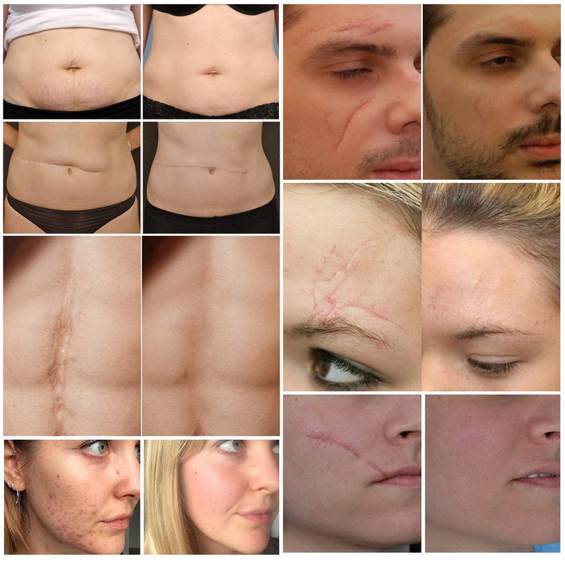 [Australia] - Scar cream, scar removal cream, advanced scar treatment gel for surgical scars, acne scars, effective for old and new scars 