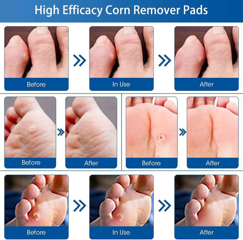 [Australia] - 48 Count Corn Removal Pads for Feet and Toe, Corn Feet Remover for Extra Strength, Callous Remover 