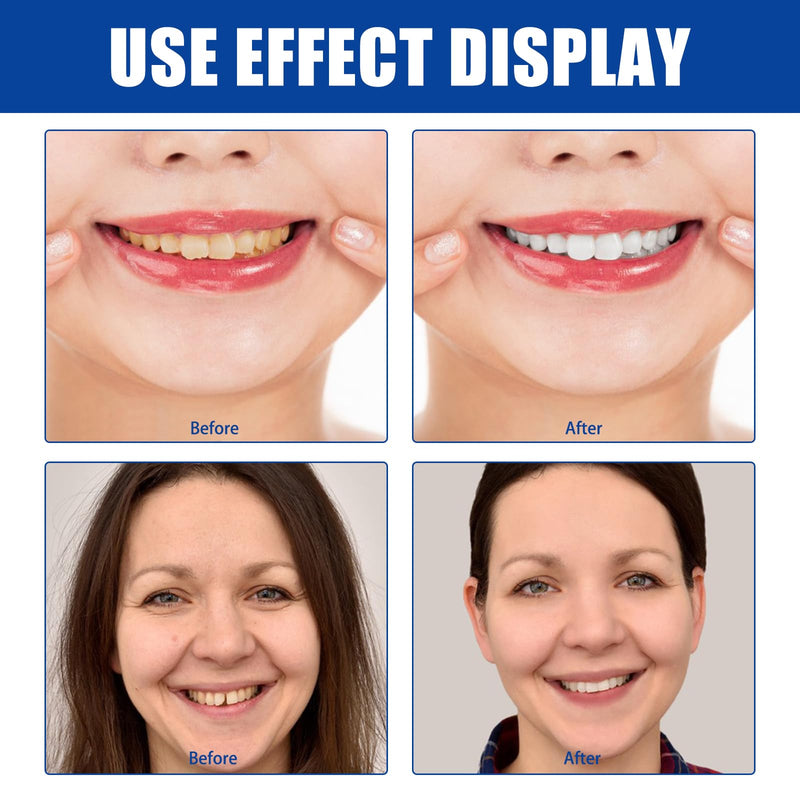 [Australia] - 2 pieces denture silicone reline kit, denture underlining silicone, denture silicone reline kit, soft denture reline kit, snap on soft denture reliner kit for upper and lower teeth 