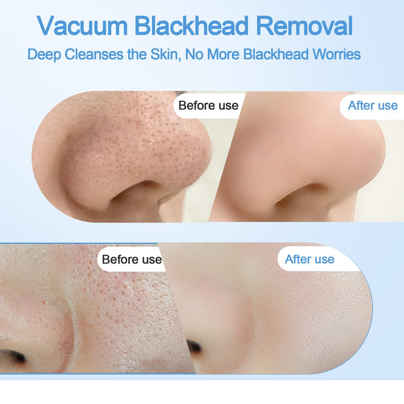 [Australia] - Blackhead Remover Vacuum with Heat & Cold Care, Black Head Remover for Face & Nose with Camera, Rechargeable Blackhead Vacuum Extractor with 3 Modes 5 Suction Levels & 6 Replaceable Heads 