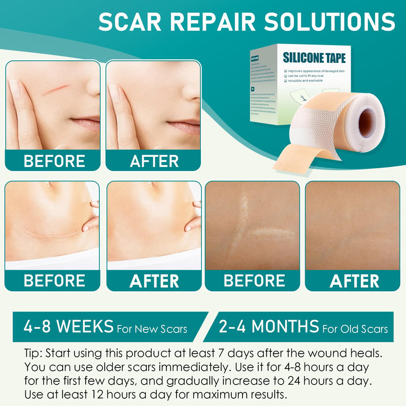 [Australia] - Silicone scar plaster, silicone plaster for scars, silicone scar tape roll, scar roller, surgical scars, silicone scar sheets for visible scar care (4 cm x 300 cm) 