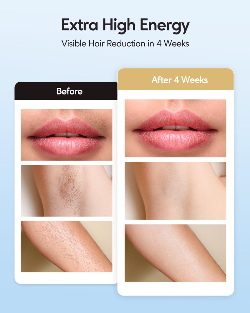 [Australia] - INNZA IPL Hair Removal with Ice Cooling Care Function for Women,Long-Lasting Results,999,999 Flashes Painless IPL Hair Remover, Hair Removal Device for Armpits Legs Arms Bikini Line Rose Gold 