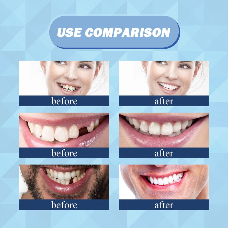 [Australia] - 30 ml Tooth Repair Kit, Temporary Teeth Replacement Kit - Moldable Thermal Fitting Beads for Filling Fix Missing and Broken Tooth or Adhesive Denture Fake Teeth 