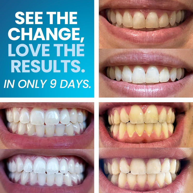 [Australia] - Emerawhite Teeth Whitening Kit - Personalized 9-Day Tooth Whitener - Professional Snow Whitening for Radiant Smiles | Enamel Safe 