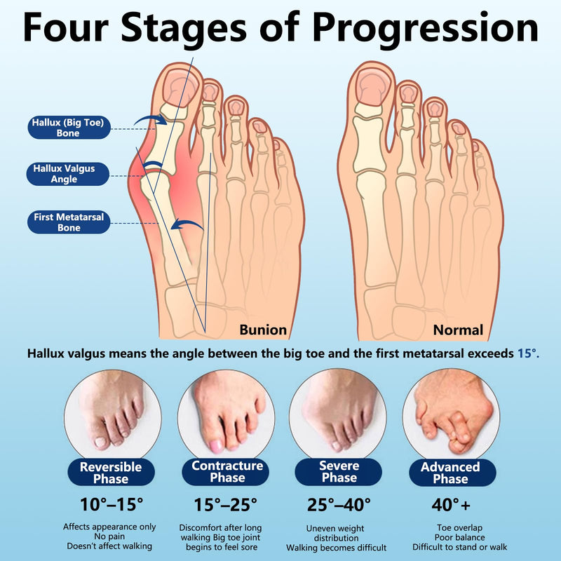 [Australia] - Bunion Corrector Pro 2.0 for Women & Men, Bunion Brace Big Toe Straightener for Left & Right Foot, Say Goodbye to Hallux Valgus (Black, 1 Pair) 