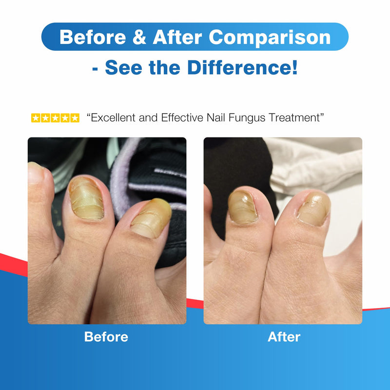 Toenail Fungus Treatment Extra Strength - DR.RAPID Toenail Fungus Treatment Pen with 25% Undecylenic Acid & Tolnaftate, Ideal for Fungus Treatment for Damaged Nails & Fingernails 5ml/0.18FLOZ 3Pcs 1 Fl Oz (Pack of 3)