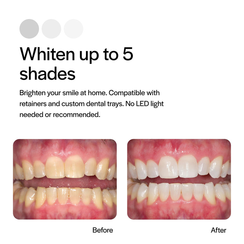 [Australia] - Opalescence 20% Teeth Whitening Refill Kit (4 Syringes) Carbamide Peroxide. Made by Ultradent, in Mint Flavor. Tooth Whitening Refill Syringes. Includes a Toothbrush. - 5196-2TB 