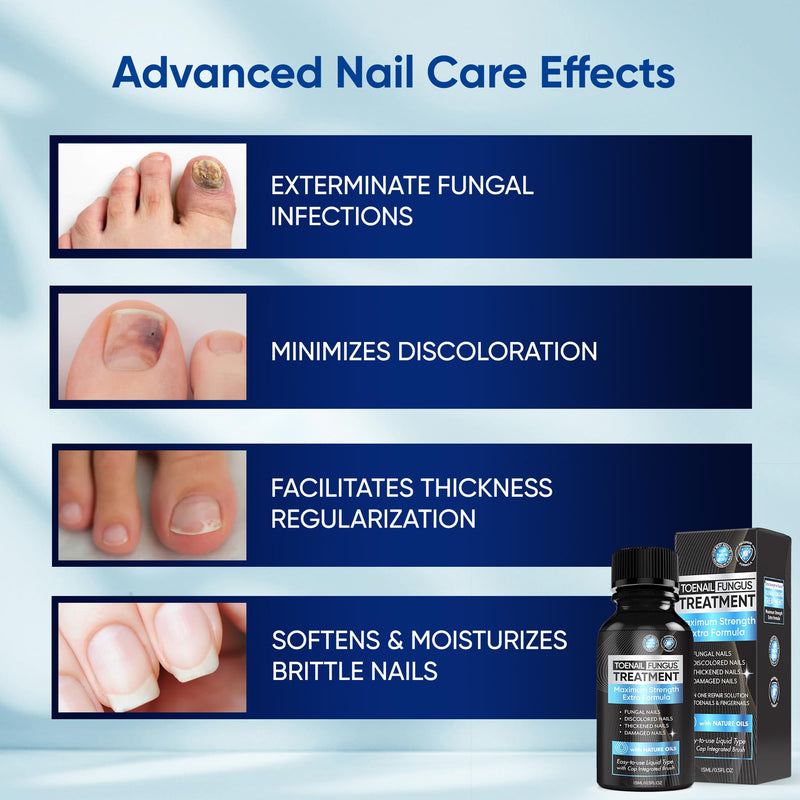 Maximum Strength Toenail Fungus Treatment with 10% Undecylenic Acid - Professional Antifungal Nail Solution for Severe, Thick & Brittle Nails 30ml