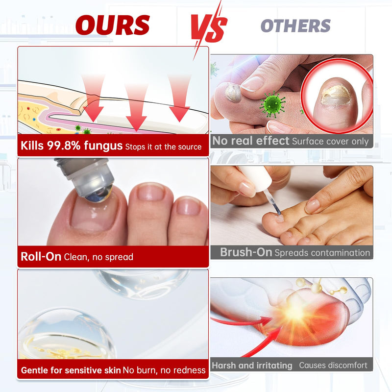 Toenail Fungus Treatment Extra Strength, 1% Tolnaftate Antifungal Fungal Nail Treatment, ToeNail Fungus Treatments For Thick Discolored Brittle Crumbling Nails, 0.51 fl oz (Pack of 1)