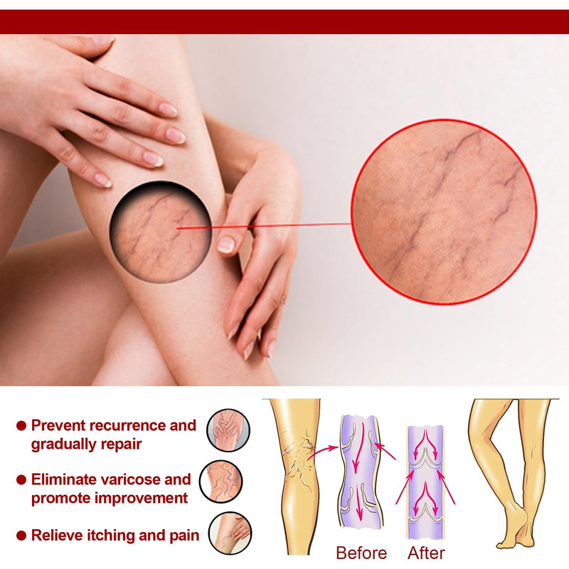 [Australia] - Grgowe Varicose Veins Cream, Varicose Veins Cream, Cream for Spider Veins, Active Veins, Anti-Varicose Veins Cream, Cream for Relieving and Preventing Varicose Veins, Improve Blood Circulation for Legs 