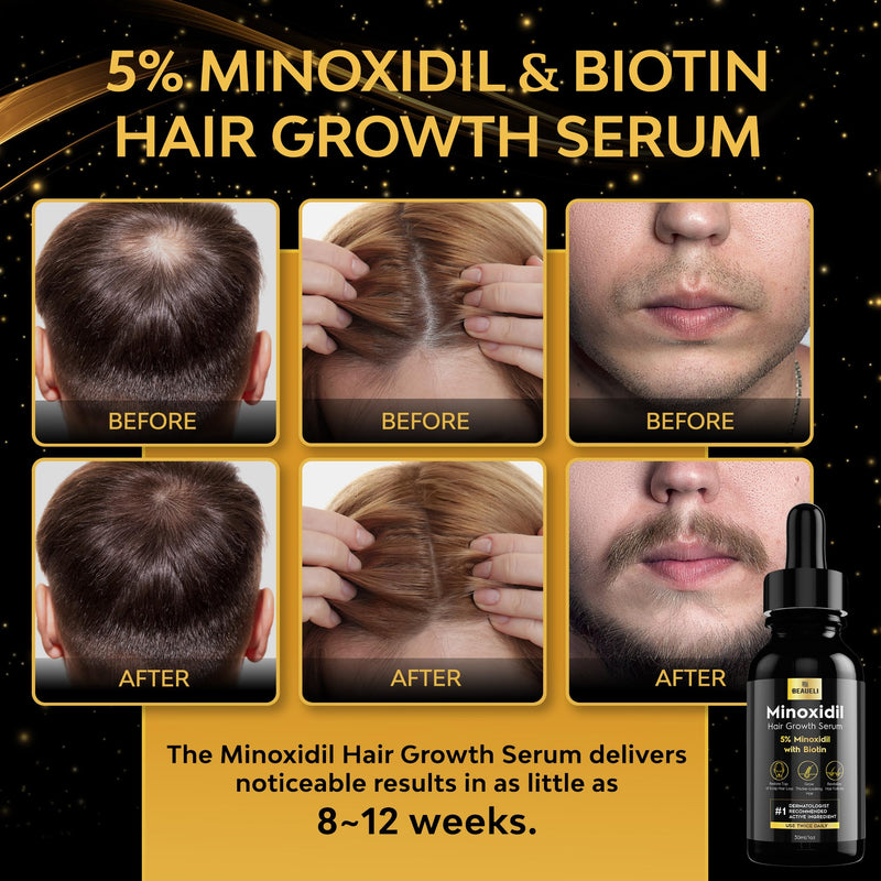 5% Minoxidil for Men & Women Hair Growth Serum, Beard Growth Oil 1oz 1pcs | Minoxidil Hair Growth Oil for Men & Women, 5% Minoxidil Serum Hair Regrowth Treatment with Biotin for Thicker, Fuller Hair 1 Fl Oz (Pack of 1) 30ml - 1 bottle
