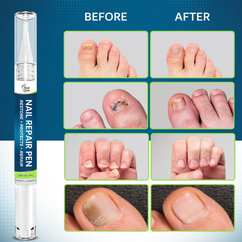 [Australia] - Footcure Antifungal Nail Treatment Pen ‚Äì Extra Strength Toenail Fungus Treatment, 25% Undecylenic Acid for Toenails & Fingernails, Nail Fungus Repair Pen with Tea Tree & Oregano Oil, Made in USA 0.1 Fl Oz (Pack of 2) 