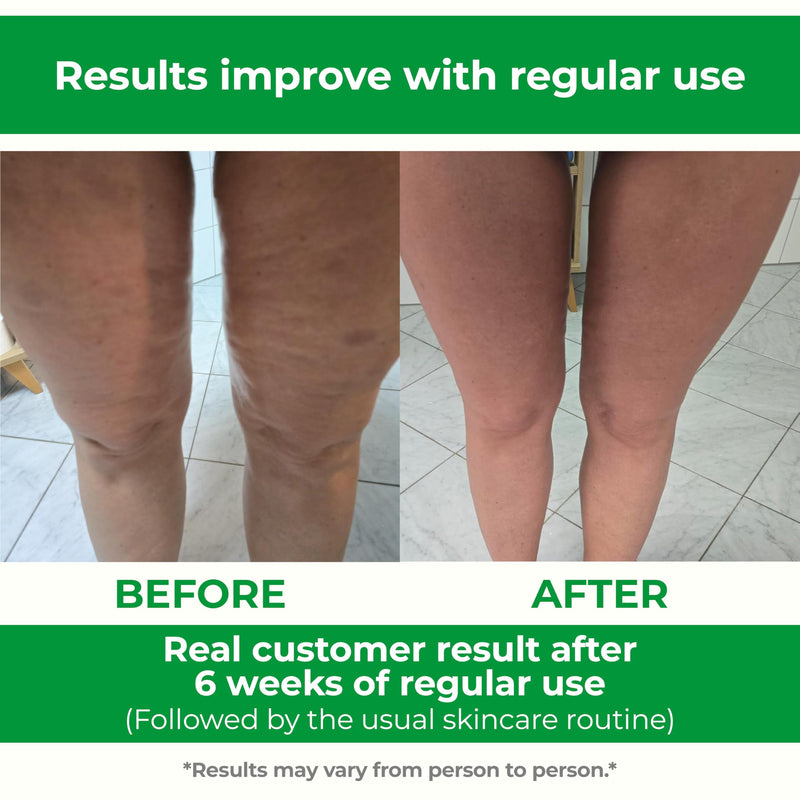 [Australia] - TESMED Cellulite Manual Massager : Made in Italy, Patented with Converging & Diverging Roller Technology. Anti Cellulite Roller for Thighs and Buttock 