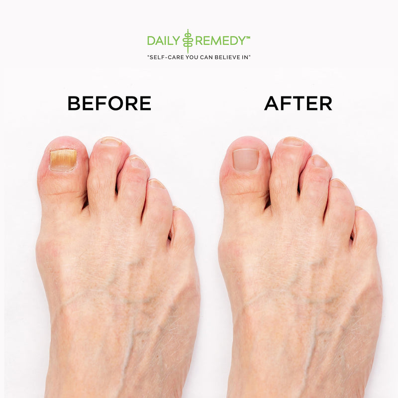 [Australia] - DAILY REMEDY EXTRA STRENGTH Tea Tree Oil Foot Soak w/ Epsom Salt Made in USA Toenails，Athlete's Foot，Itchy Feet，Stubborn Smelly Foot Odor，Pedicure Calluses & Soothes Sore Tired Achy Feet 16 oz，Black Tea Tree Oil w/ Apple Cider Vinegar 1 Pound (Pack of 1) 