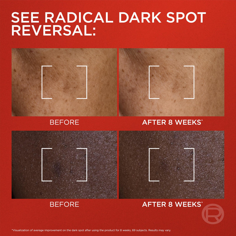 L'Oreal Paris Revitalift Triple Power Dark Spot Corrector Creamy-Serum, Hyperpigmentation Treatment With Melasyl, Vitamin C & Niacinamide, Treats Sun Spots, Dark Spots, Aging & Uneven Tone, 1.7 fl oz