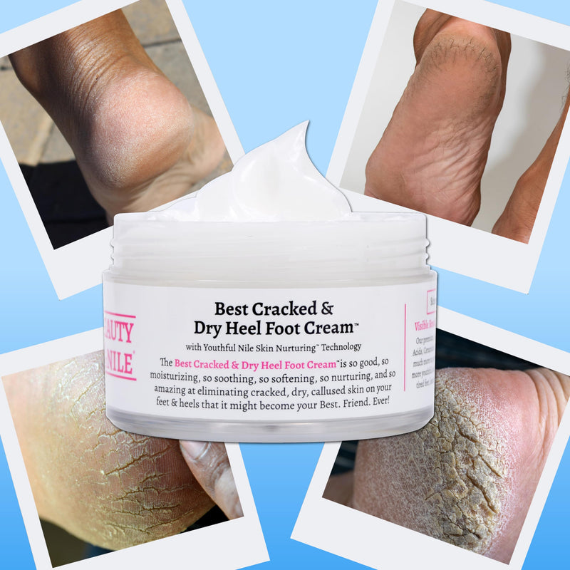 [Australia] - Best Cracked & Dry Heel Foot Cream™ Urea Ceramides Heels Feet Knees Elbows Hands Dead Skin Cuticle Callus Remover Nail Softener Keratolytic Repair Mango Cocoa Shea 5oz 