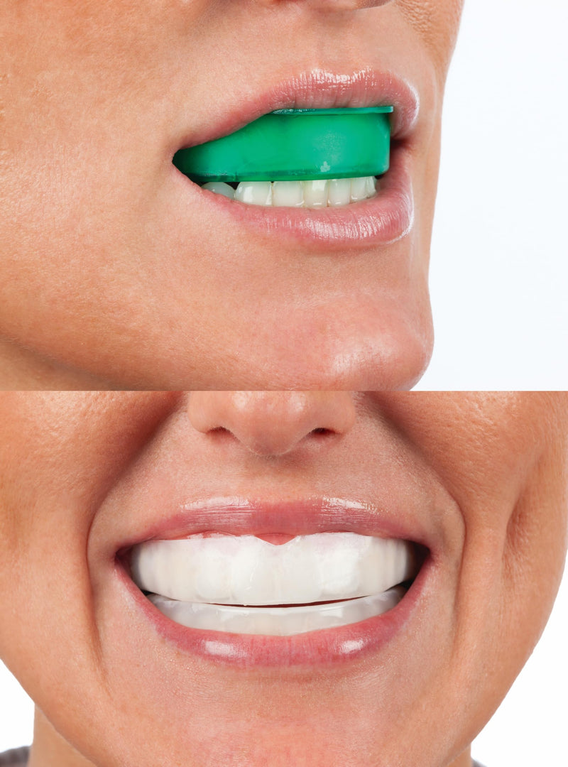 [Australia] - Opalescence Go - Prefilled Teeth Whitening Trays - Original 15% - (4 Treatments) - Hydrogen Peroxide with PF - Cool Mint - Made by Ultradent. 4648-1 1 Count (Pack of 4) 