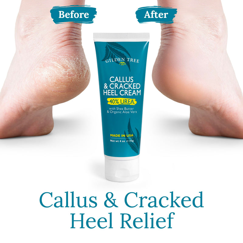 Urea Cream 40 Percent for Feet Maximum Strength Cracked Heel Treatment Foot Cream for Calluses and Dry Feet, Enriched with Shea Butter & Aloe for Moisturizing, Made in USA 40% Urea Cream