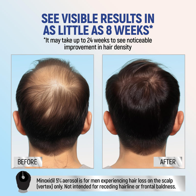 Minoxidil 5% Topical Aerosol Foam, Hair Regrowth 4 Months Treatment for Men, 2.11 oz (4 Pack) 2.11 Ounce (Pack of 4)