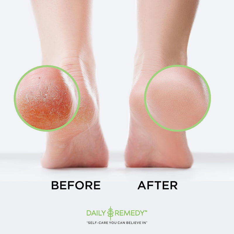 [Australia] - DAILY REMEDY EXTRA STRENGTH Tea Tree Oil Foot Soak w/ Epsom Salt Made in USA Toenails，Athlete's Foot，Itchy Feet，Stubborn Smelly Foot Odor，Pedicure Calluses & Soothes Sore Tired Achy Feet 16 oz，Black Tea Tree Oil w/ Apple Cider Vinegar 1 Pound (Pack of 1) 