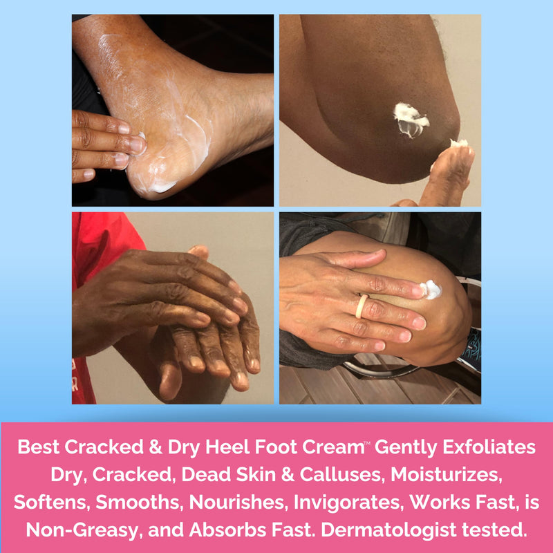 [Australia] - Best Cracked & Dry Heel Foot Cream™ Urea Ceramides Heels Feet Knees Elbows Hands Dead Skin Cuticle Callus Remover Nail Softener Keratolytic Repair Mango Cocoa Shea 5oz 