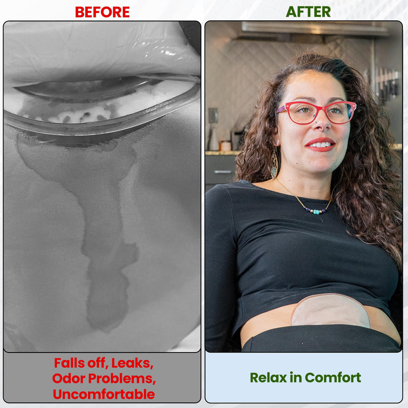 [Australia] - 15 Pack Ostomy Supplies & Colostomy Bags Kit ‚Äì Double-Reinforced Leakproof Seal - 15 One-Piece Bags & 15 2MM Barrier Rings - Cut-to-Fit, Unisex, Skin-Friendly 