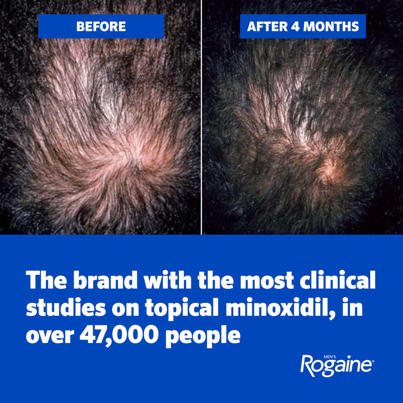 Men's Rogaine 5% Minoxidil Topical Foam, Unscented, 3 Mo Supply, 3x 2.11 Oz | Hair Regrowth Foam, Topical Hair Loss Treatment for Men, Regrow Fuller, Thicker Hair, Unscented, Aerosol, 3-Month Supply 2.11 Ounce (Pack of 3)