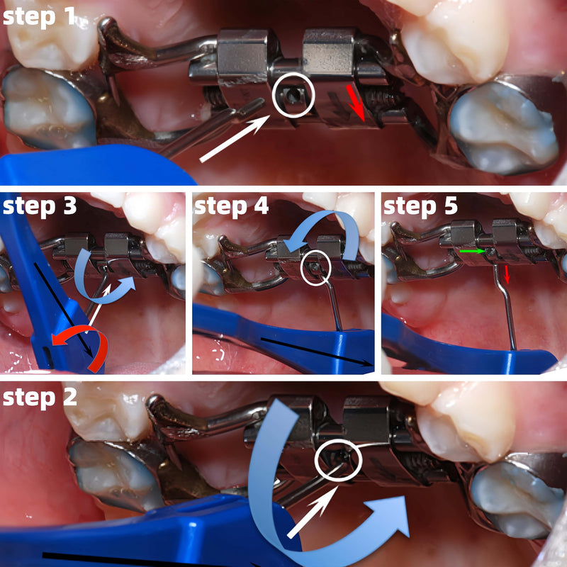 expander Key-Dental Orthodontic Expansion Swivel Key Tool for Palatal Expanders.