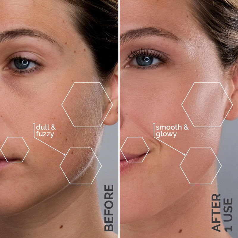 [Australia] - Michael Todd Beauty - Sonicsmooth – SONIC Technology Dermaplaning Tool - 2 in 1 Women’s Facial Exfoliation & Peach Fuzz Hair Removal System with 8 Weeks of Dermaplaning Blades 