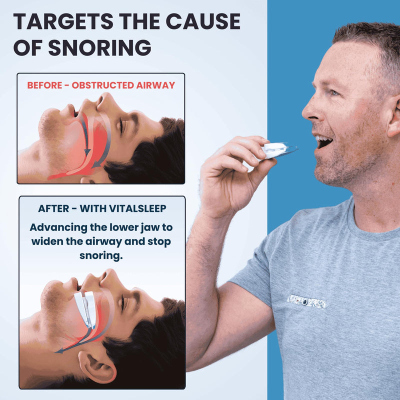 [Australia] - VitalSleep Anti-Snoring Mouthpiece + Cleaner, Men's Size – Adjustable, Custom-Fit Snoring Remedy – Comfortable Sleep Aid Mouthguard for Restful Nights – USA-Made, FDA-Cleared 