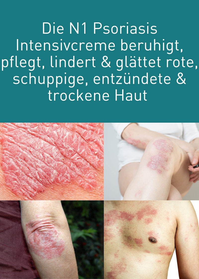 [Australia] - N1 Psoriasis Intensive Cream 50 ml - Eczema & Neurodermatitis Cream - soothes, nourishes, soothes and smoothes red, flaky, inflamed & dry skin 50 ml (pack of 1) 