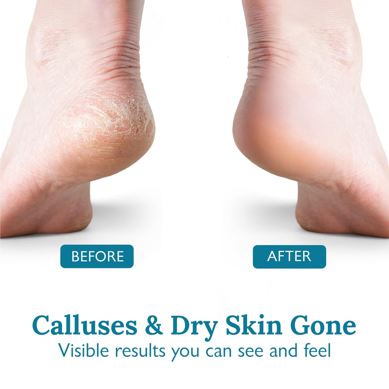 [Australia] - Gilden Tree Foot Callus Remover Kit - 40% Urea Cream & Handmade Terra-Cotta Pumice Stone for Feet - Callus Remover for Feet with Shea Butter & Aloe Vera - Cracked Heel Treatment & Moisturizer 