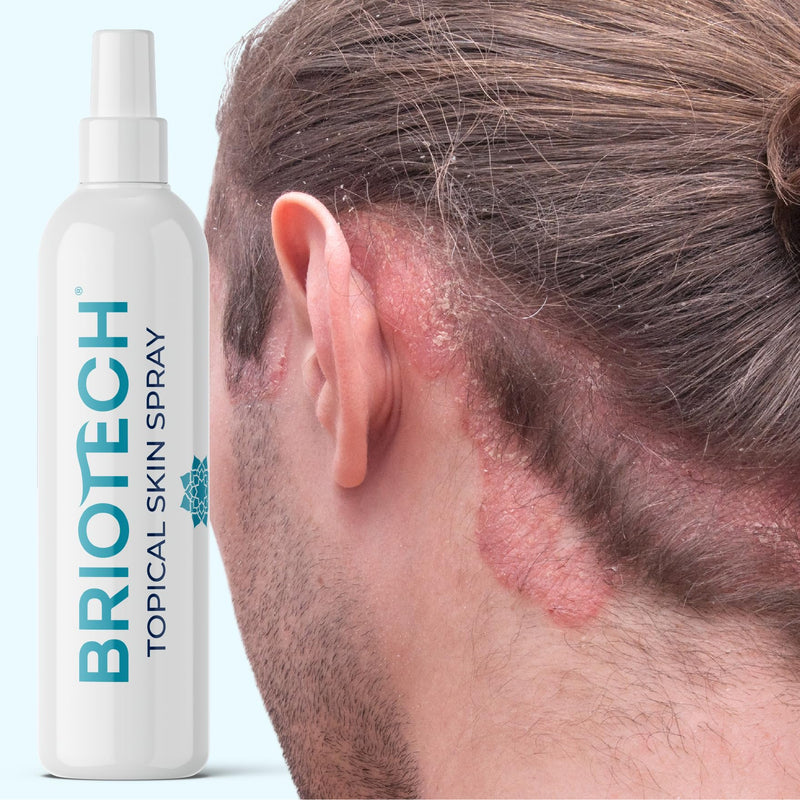 [Australia] - BRIOTECH Topical Skin Spray, Hypochlorous Acid Spray for Body & Face, Eyelid Cleanser, HOCl Facial Mist, Support Against Irritation, Calm Redness, Soothe Foot & Scalp, Packaging May Vary, 3.4 oz, 1 ct 3.4 Fl Oz (Pack of 1) 