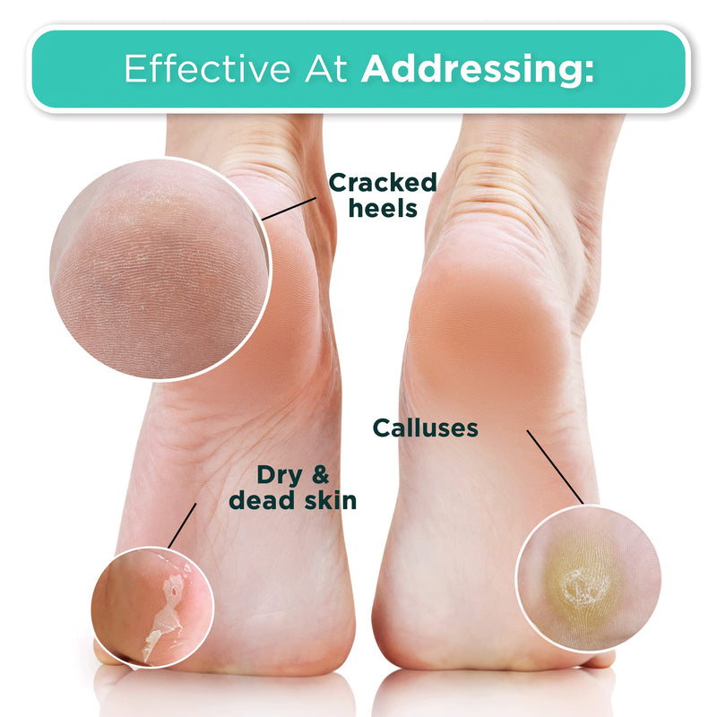 [Australia] - DERMORA Foot Peel Mask - 2 Pack of Regular Size Skin Exfoliating Foot Masks for Dry, Cracked Feet, Callus, Dead Skin Remover for Baby Soft Feet, Original Scent 2 Count (Pack of 1) Scent: Original 