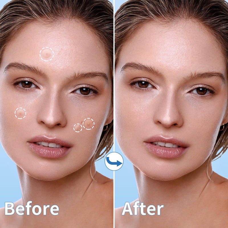 [Australia] - Pimple Patches for Face, 4 Size 300 Counts Acne Patches, Hydrocolloid Patches for Covering Zits and Blemishes, Spot Stickers with Salicylic Acid, Tea Tree Oil & Calendula Oil 