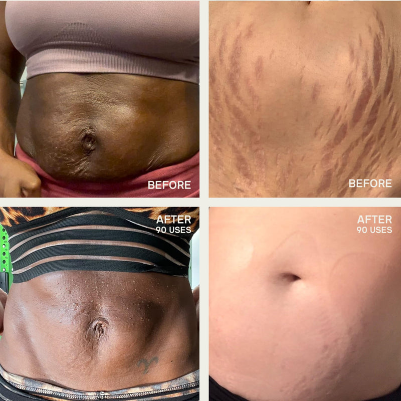 [Australia] - Dermaclara Large Body Patch - Pregnancy Stretch Mark Prevention & Removal, C Section Cover Up Belly Scar Sheet, Maternity Skincare, Mom to Be Silicone Gel Sheet, Reusable up to 30 Times - 1 Patch Body Patch 7" Patch 