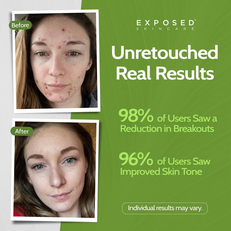 Exposed Skin Care Moisture Complex Oil-Free Daily Face Moisturizer | Non-Comedogenic, Lightweight Hydrating Gel, Green Tea Extract, Pumpkin Seed, Caffeine, For Oily and Acne-Prone Skin